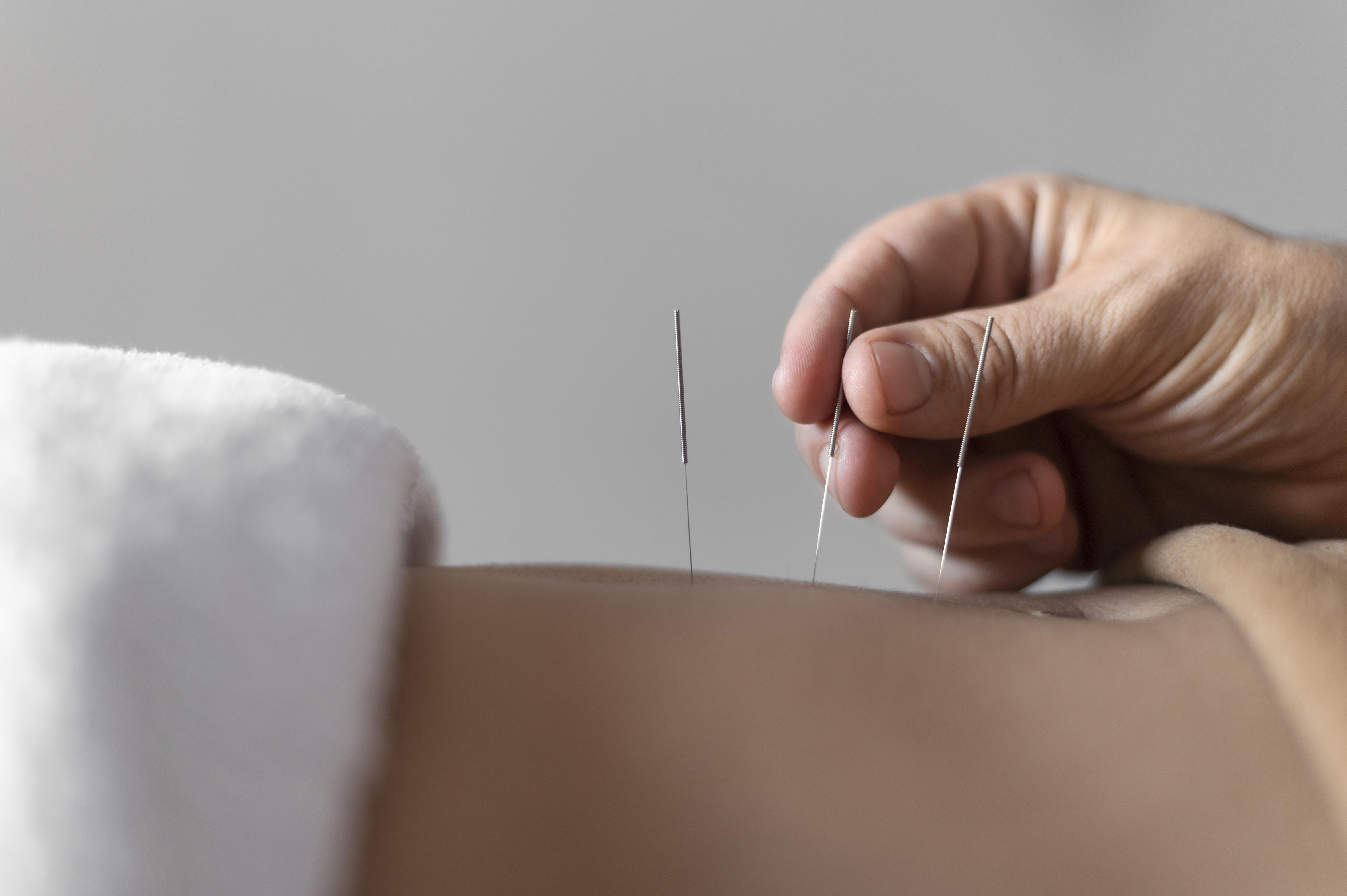 Dry Needling
